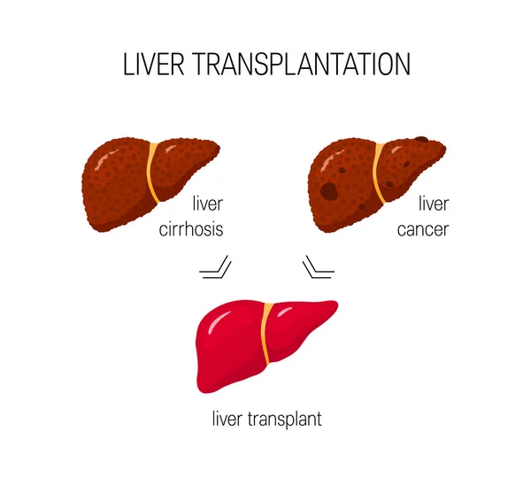 Concept Transplantation Hépatique Dans Style Dessin Animé — Image vectorielle