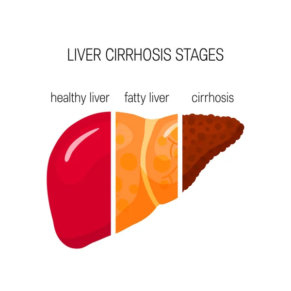 Liver Cirrhosis Concept Vector Illustration Healthy Fatty Cirrhosis Liver Cartoon — Stock Vector