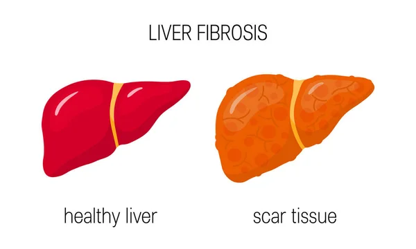 Leberfibrose Vektorillustration Einer Gesunden Und Beschädigten Leber Flacher Form — Stockvektor