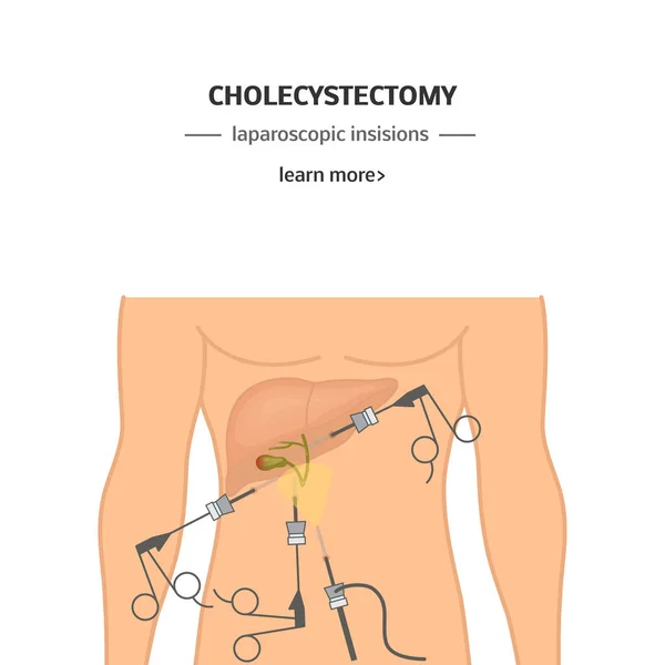 Cholecystektomii Chirurgiczne Usunięcie Pęcherzyka Żółciowego Ilustracja Wektorowa Banery Lub Reklamy — Wektor stockowy