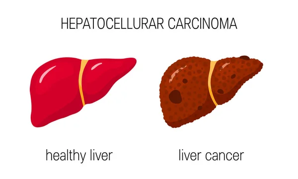 Hepatocellurar Carcinoma Koncept Vektorillustration Friska Och Hcc Lever Tecknad Stil Stockvektor