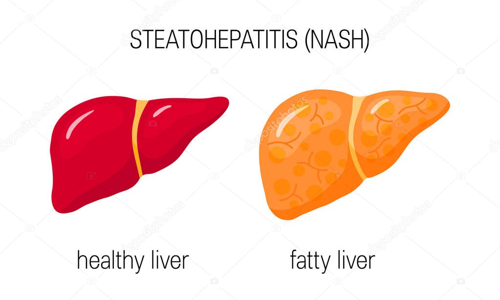 Non-alcoholic steatohepatitis (NASH). Vector illustration of a healthy and a fatty liver in flat style