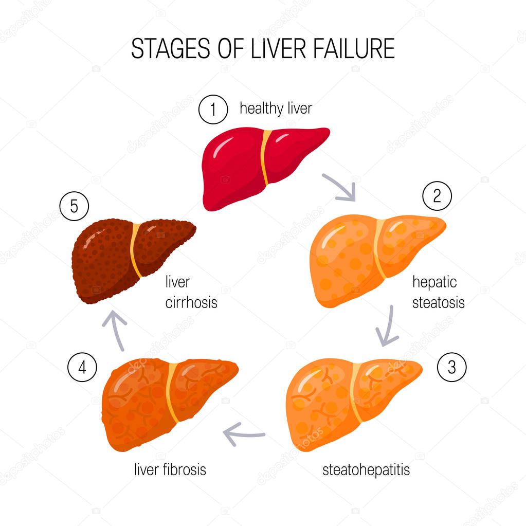 Stages of liver failure concept. Vector illustration of healthy, fatty and fibrotic ans cirrhotic liver in cartoon style