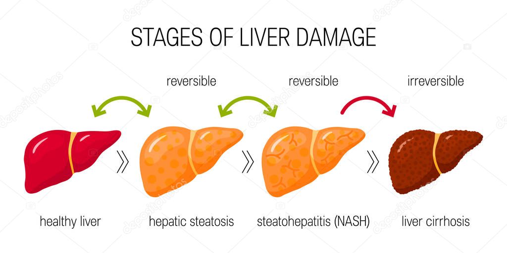 Stages of liver damage concept. Vector illustration of reversible and irreversible liver conditions in flat style