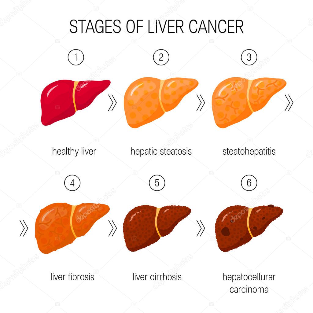 Stages of liver damage concept. Vector illustration of healthy liver, steatosis, NASH, fibrosis, cirrhosis and cancer in cartoon style