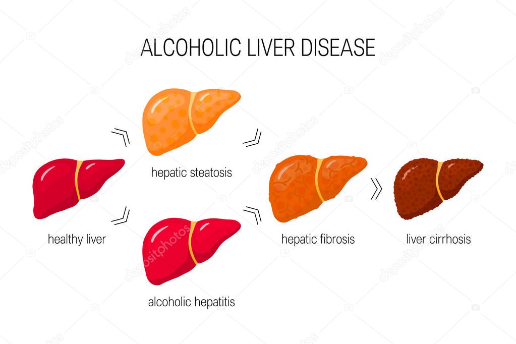 Stages of alcoholic liver disease. Vector illustration of healthy liver, steatosis, hepatitis, fibrosis and cirrhosis in cartoon style