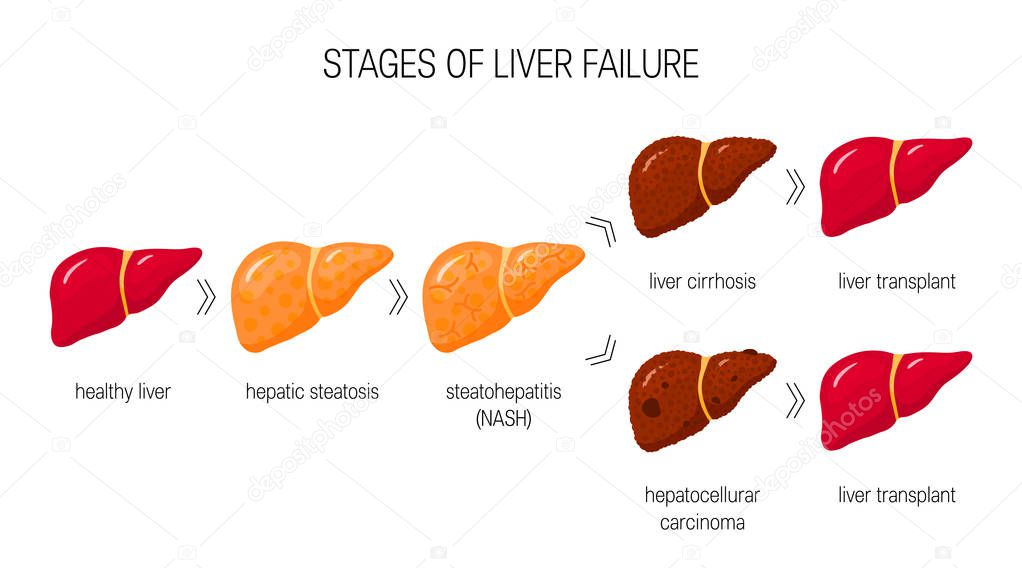 Stages of liver failure concept. Vector illustration of healthy liver, steatosis, NASH, cirrhosis and cancer in cartoon style