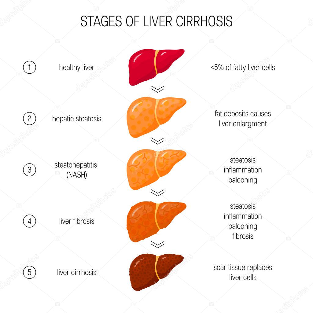 Stages of liver failure concept. Vector illustration of healthy, fatty, NASH, fibrotic and cirrhotic liver in flat style