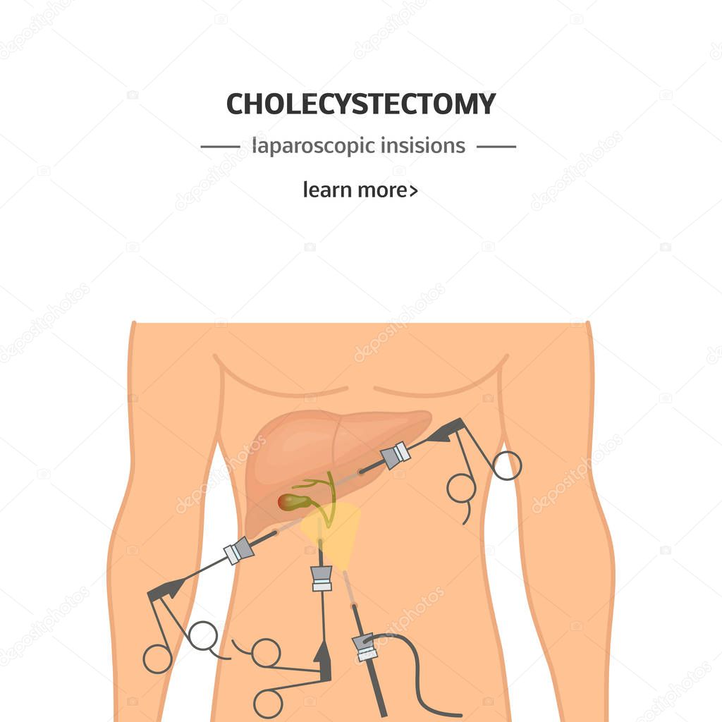 Cholecystectomy - surgical removal of the gallbladder. Vector illustration for banners or web ads