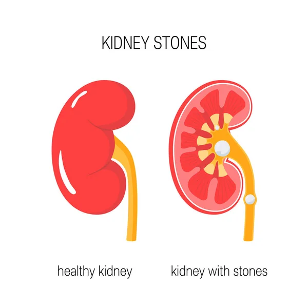 肾脏与石头向量 — 图库矢量图片