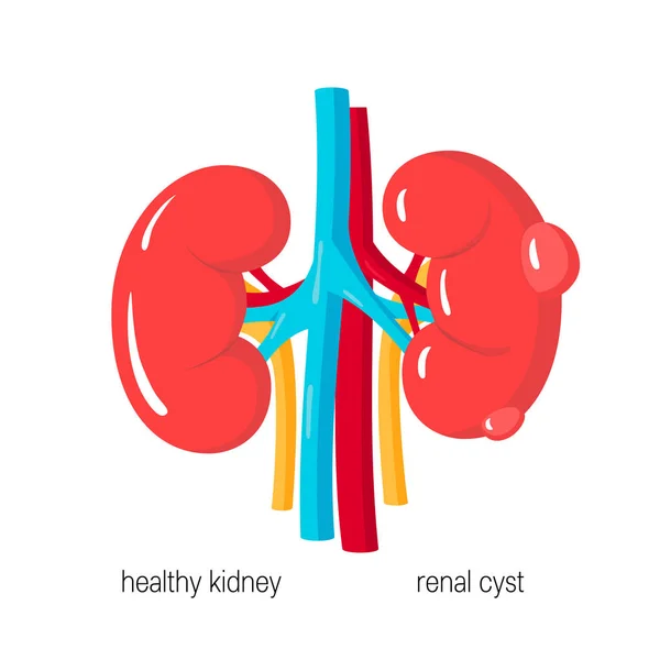 Polycysteuze nieren ziekte vector — Stockvector