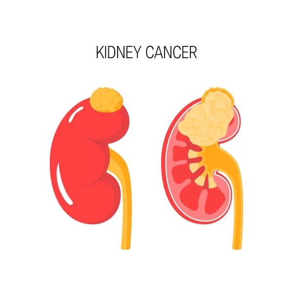 Concepto de vector de cáncer renal — Archivo Imágenes Vectoriales