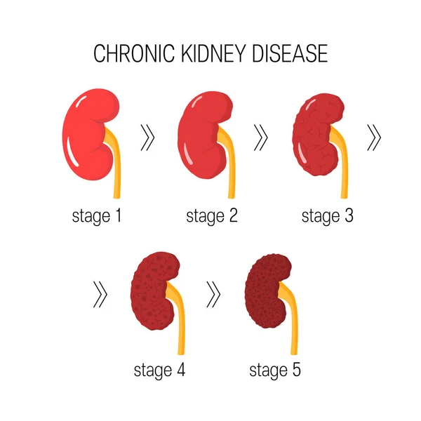 Enfermedad renal crónica vector — Vector de stock