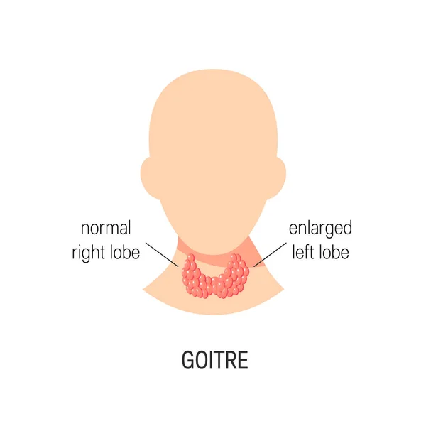 Vecteur de maladie de Goitre — Image vectorielle