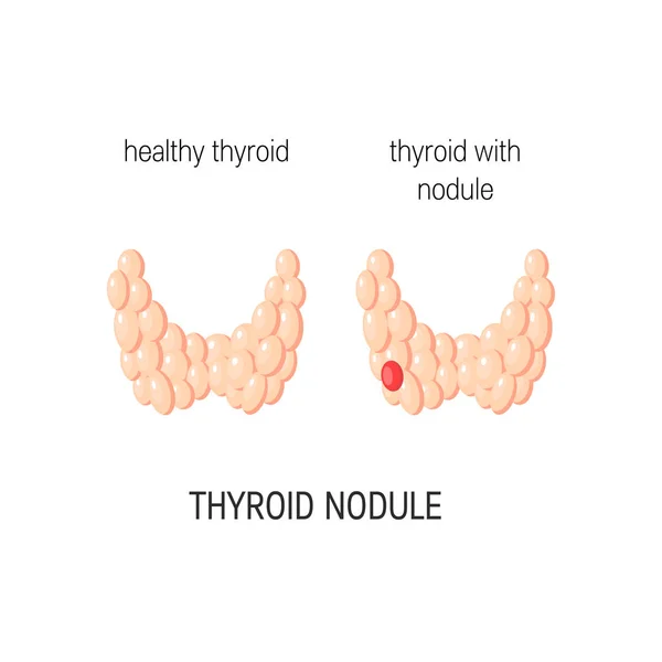 Vecteur de glande thyroïde — Image vectorielle