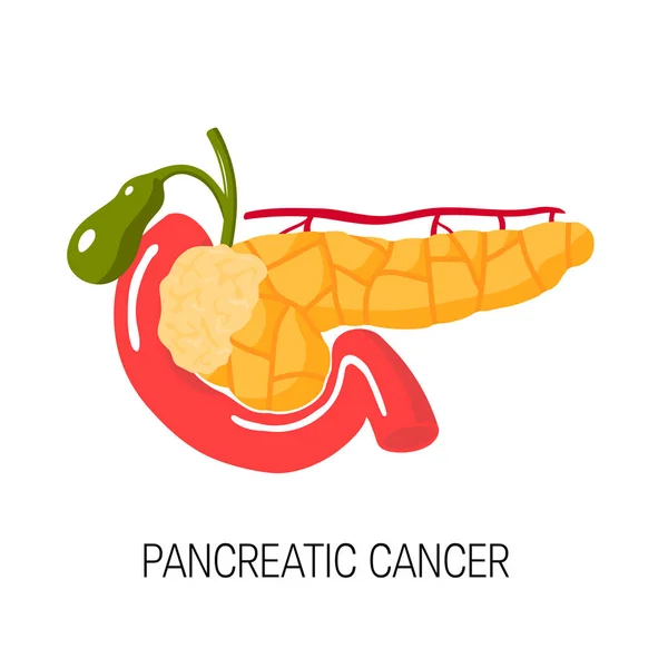 Conceito de cancro do pâncreas. Ilustração vetorial — Vetor de Stock