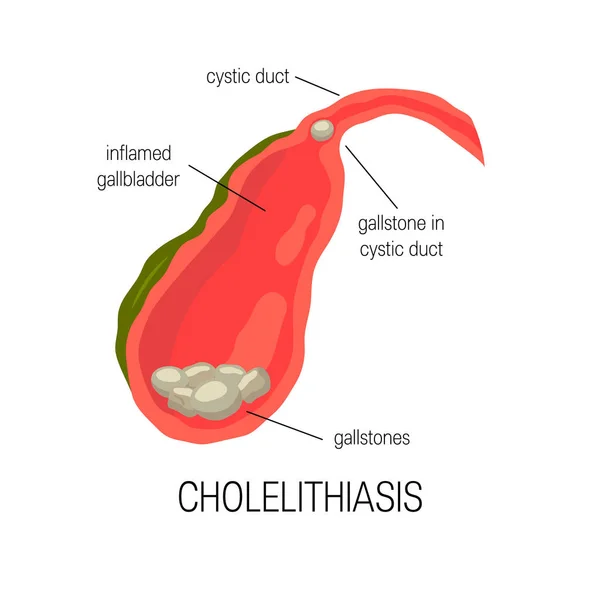Vésicule biliaire enflammée, concept de cholélithiase — Image vectorielle