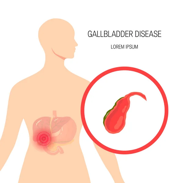 Medicinsk illustration av gallgången, vektor — Stock vektor