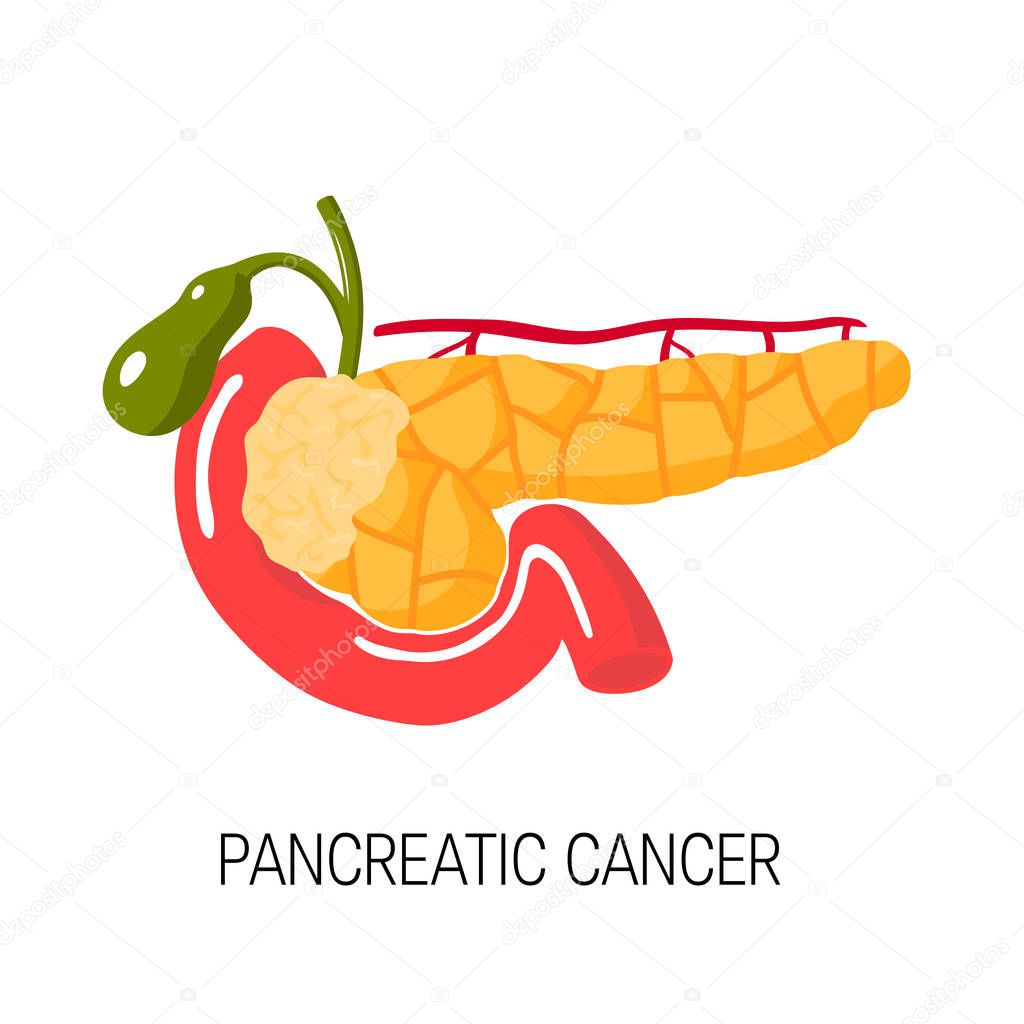 Pancreatic cancer concept. Vector illustration