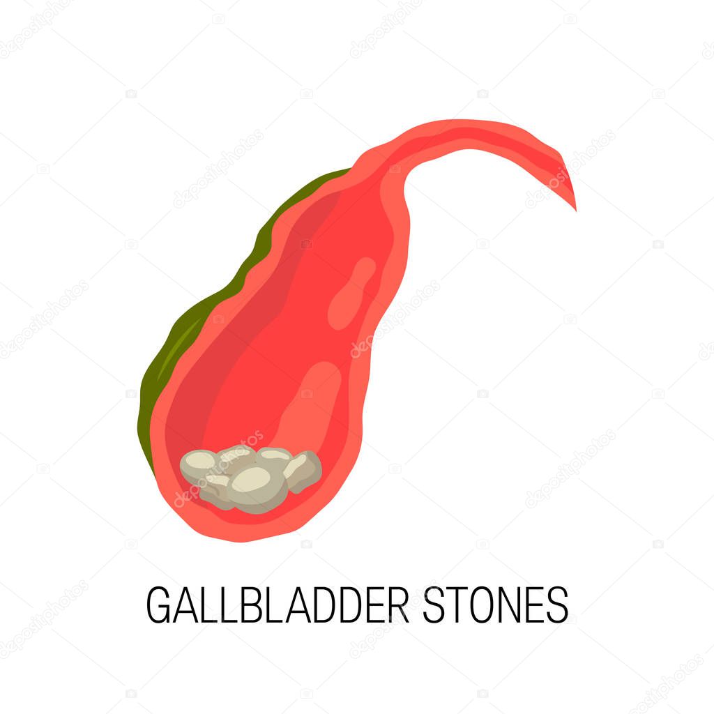 Inflamed gallbladder, cholelithiasis concept