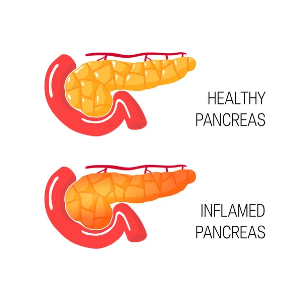 Inflama o conceito de pâncreas. Ilustração vetorial —  Vetores de Stock