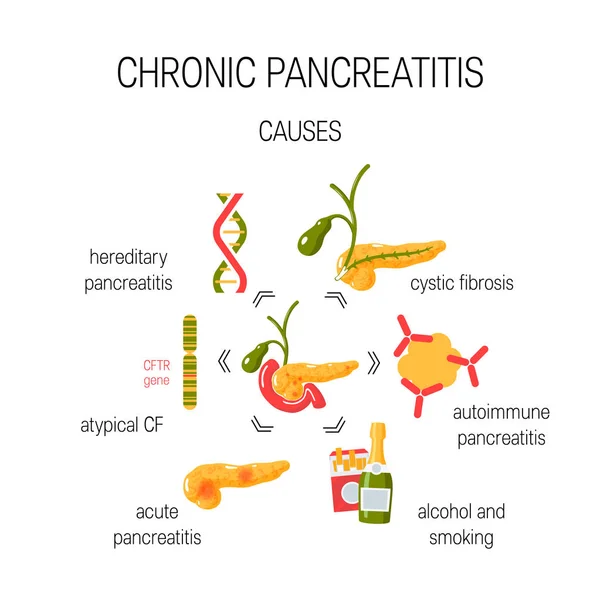 Причины хронического панкреатита. Векторная иллюстрация — стоковый вектор