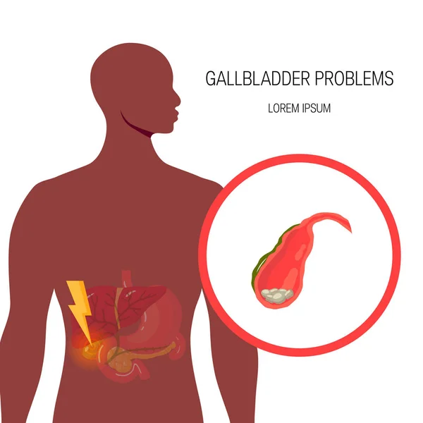 Medische illustratie van de gal duct, vector — Stockvector