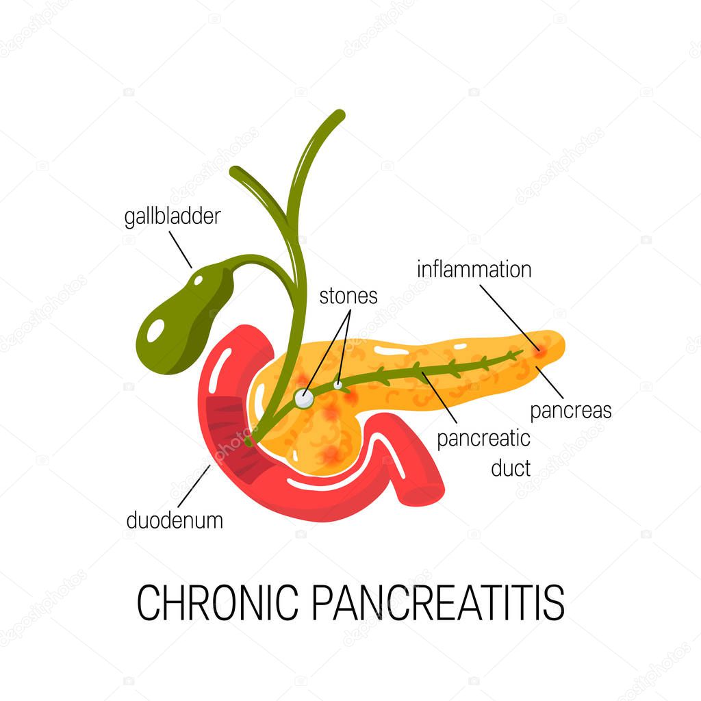 Chronic pancreatitis concept. Vector illustration