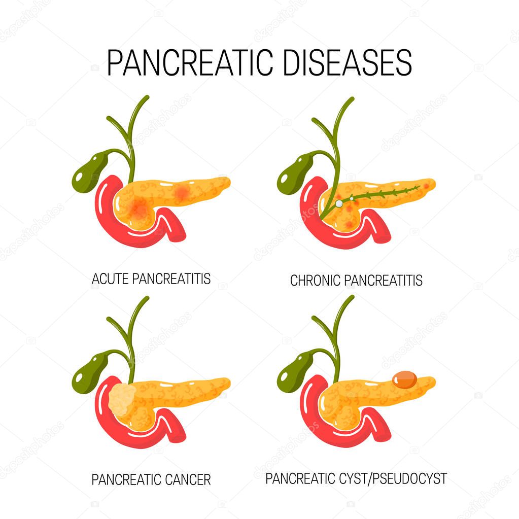 Diseases of the pancreas concept. Vector illustration