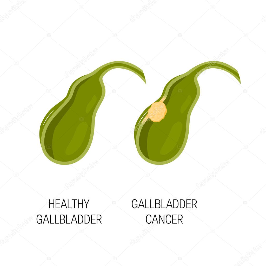 Healthy and cancer gallbladder, vector concept