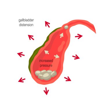 İltihaplı safra kesesi, cholelithiasis kavramı