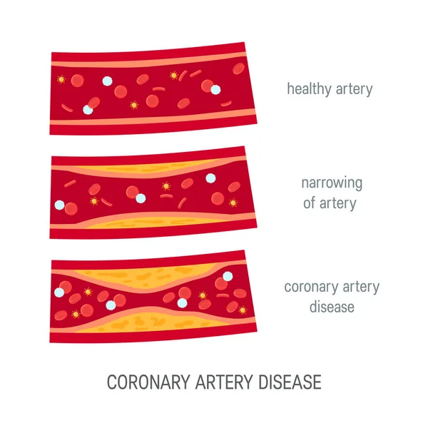 Концепция заболевания коронарной артерии в плоском стиле — стоковый вектор
