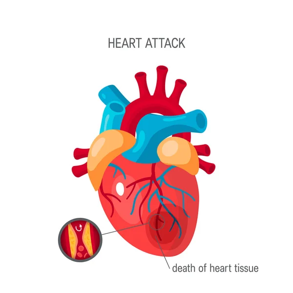 Concepto de ataque al corazón en estilo plano, vector — Vector de stock