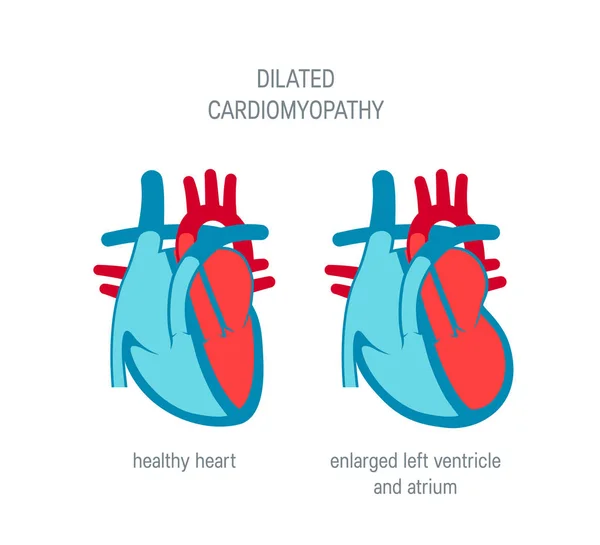 Concept de vecteur de maladies cardiaques à plat — Image vectorielle