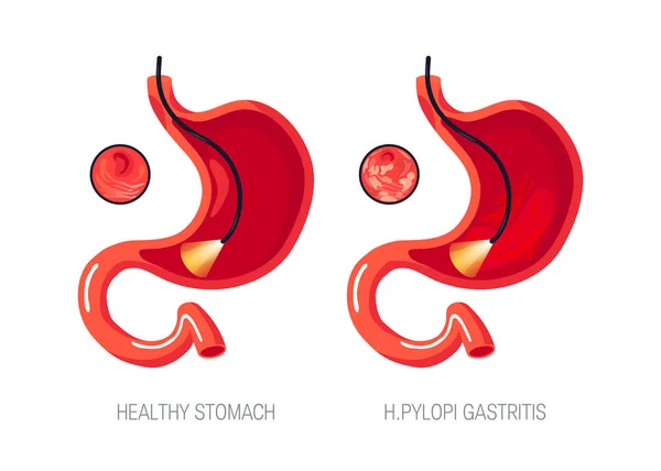 Concepto de gastritis en estilo plano, icono vectorial — Vector de stock