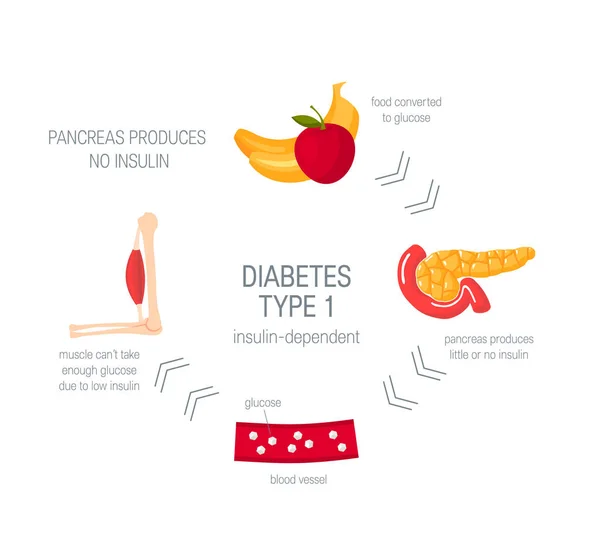 Concepto de diabetes tipo 1 en estilo plano, vector — Archivo Imágenes Vectoriales