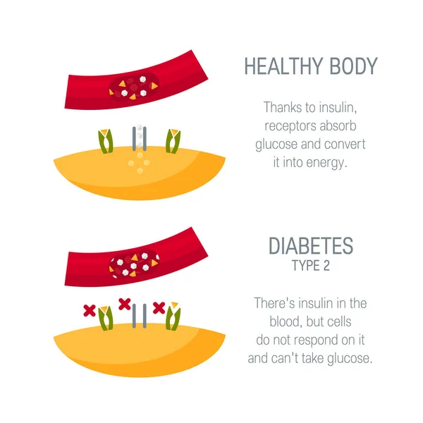 Concepto de diabetes tipo 2 en estilo plano, vector — Vector de stock