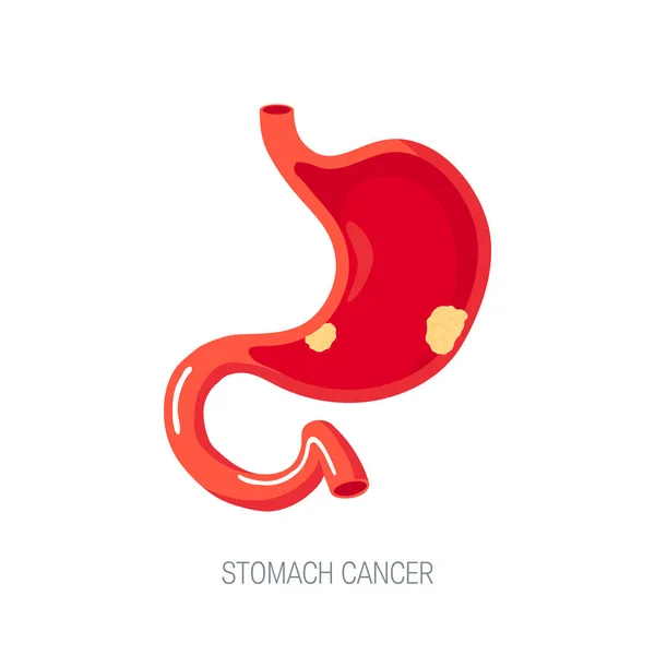 Έννοια του καρκίνου του στομάχου σε επίπεδη στυλ εικονίδιο του φορέα — Διανυσματικό Αρχείο