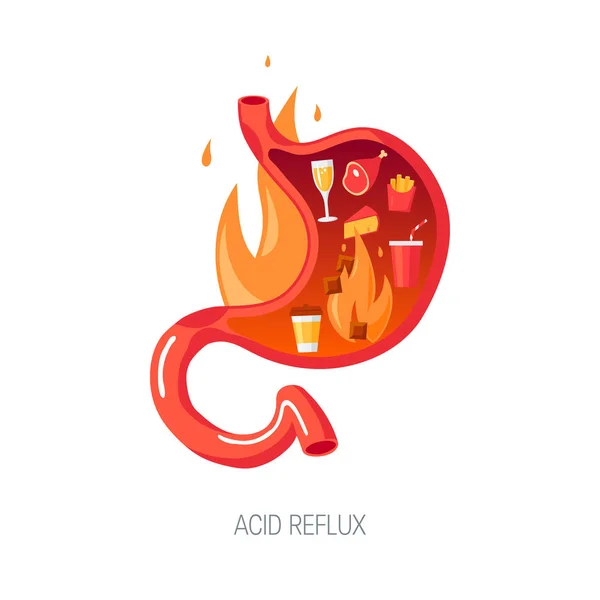 Concept GERD en style plat, illustration vectorielle — Image vectorielle