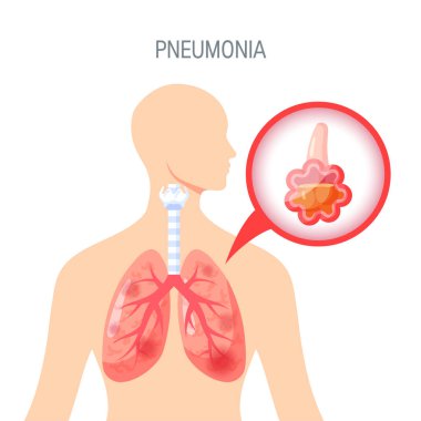 Pnömoni hastalık vektör simge düz tarzı