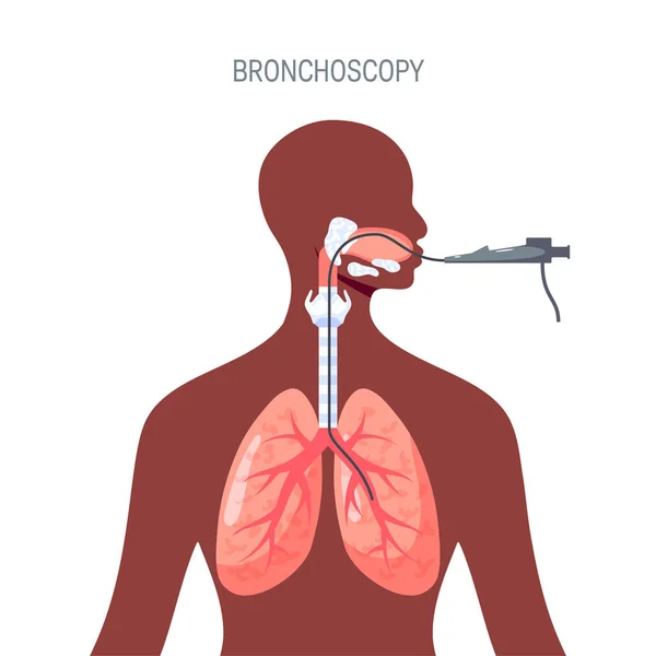 扁平型肺诊断矢量设计 — 图库矢量图片