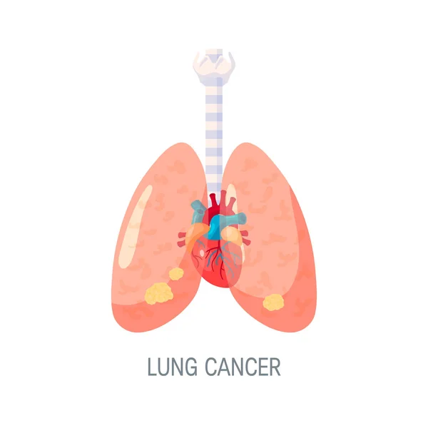 Conceito de vetor de câncer de pulmão em estilo plano — Vetor de Stock