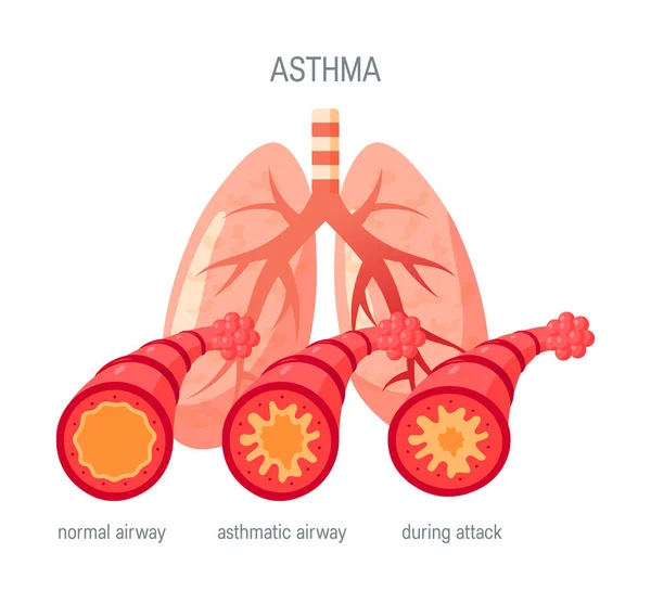 Asma enfermedad vector icono en estilo plano — Vector de stock