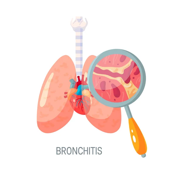 Bronquitis enfermedad vector icono en estilo plano — Vector de stock