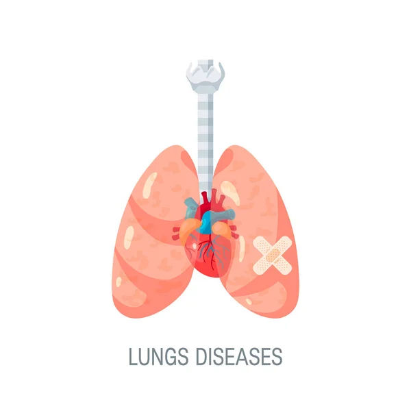 Concepto de vector de enfermedades pulmonares humanas en estilo plano — Vector de stock
