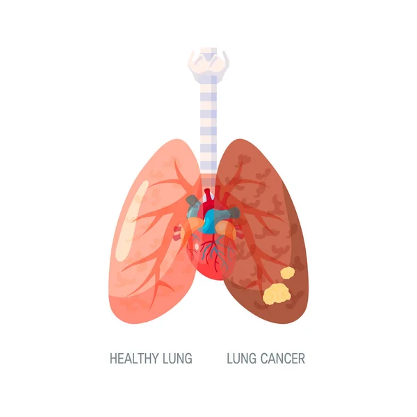 Concepto de vector de cáncer de pulmón en estilo plano — Archivo Imágenes Vectoriales