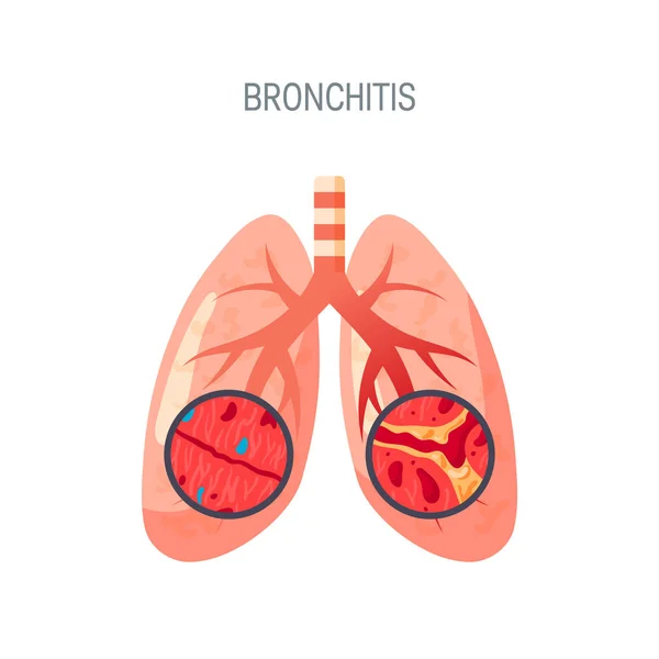 Bronquitis enfermedad vector icono en estilo plano — Vector de stock
