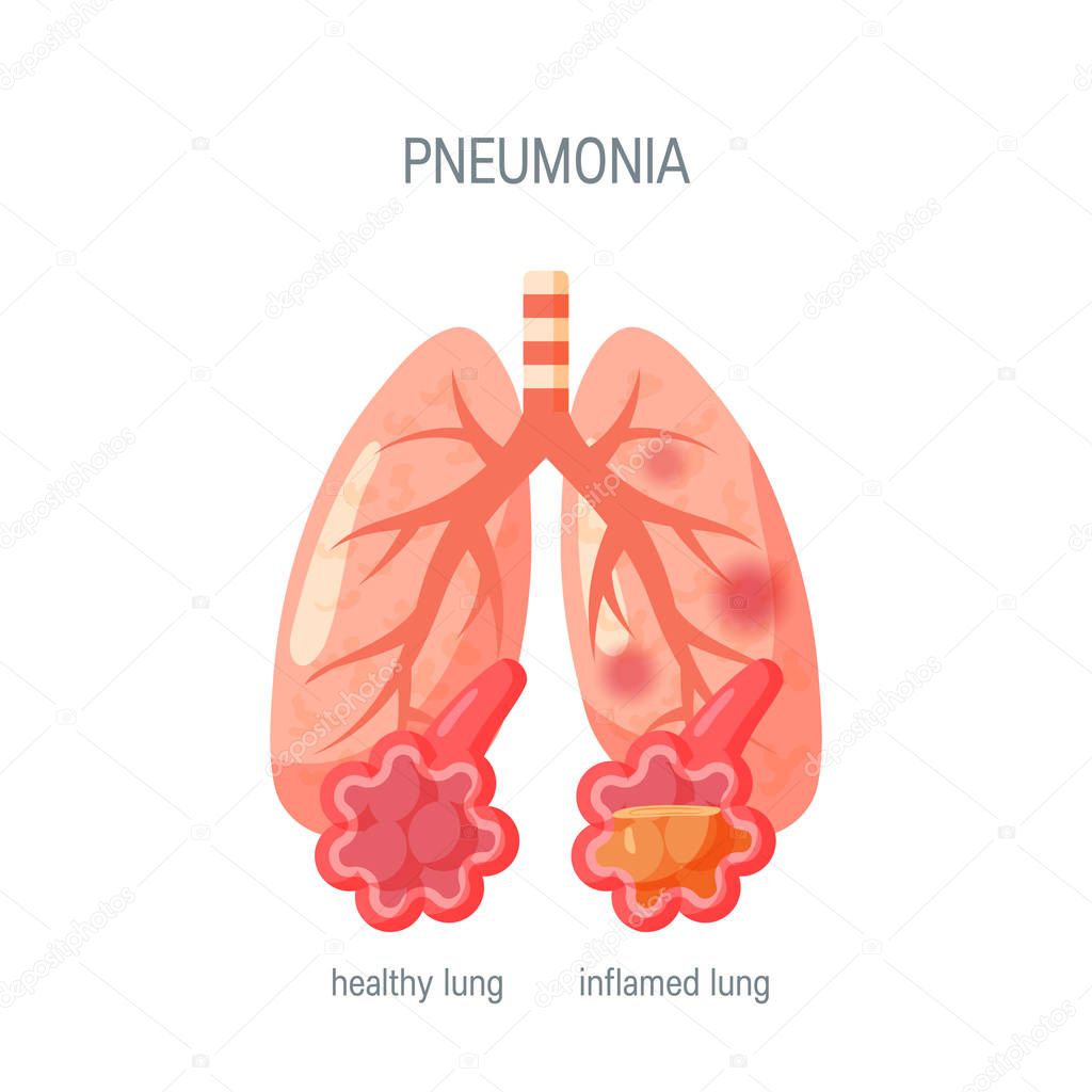 Pneumonia disease vector icon in flat style