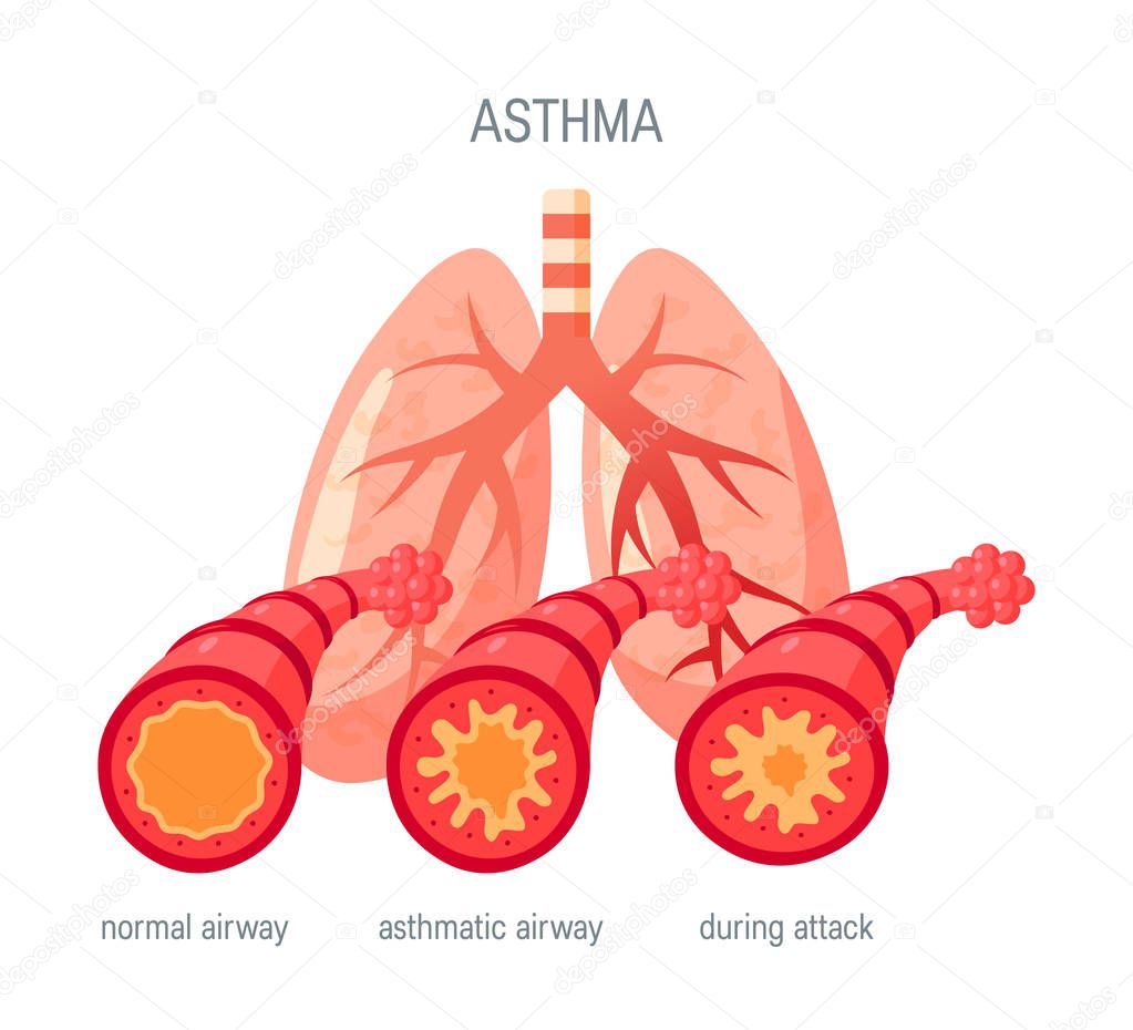 Asthma disease vector icon in flat style