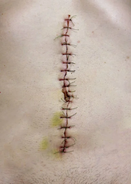 Surgical suture after abdominal cavity surgery, close - up view of surgical suture